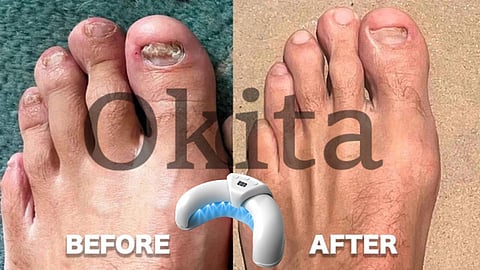 Okita Nail Fungus Light Before And After