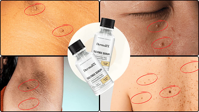 Use The Dermarx Skin Tag Remover