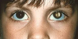 Childhood Eye Cancer Retinoblastoma