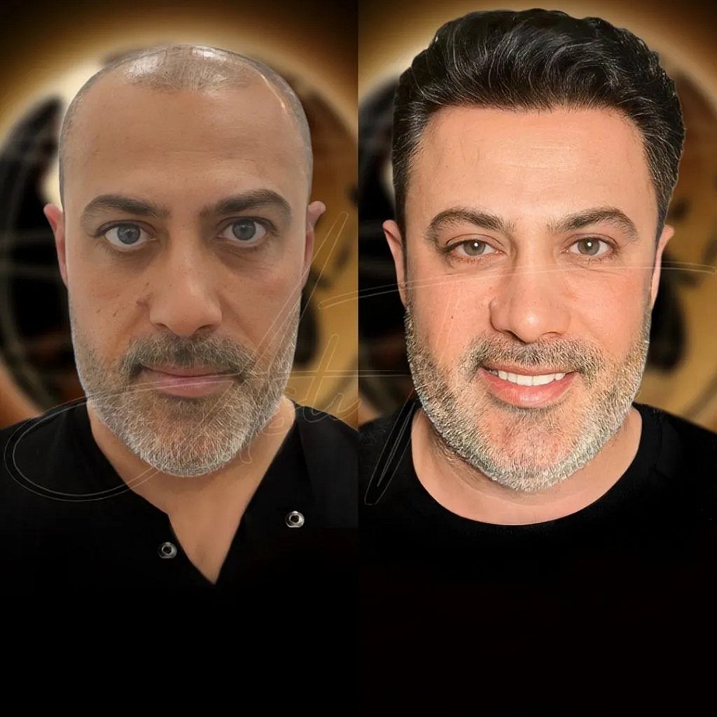 From thinning hair to a fuller, natural look – restored by the experts at the Aslı Tarcan Clinic