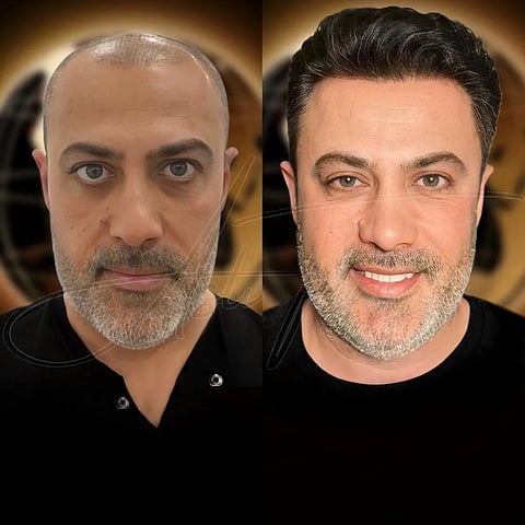 From thinning hair to a fuller, natural look – restored by the experts at the Aslı Tarcan Clinic