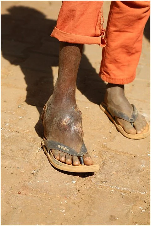 A man with Mycetoma showing his foot
