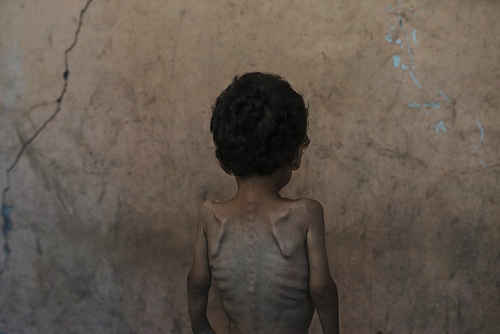 Yazan Abu Ful, a 2-year-old malnourished child