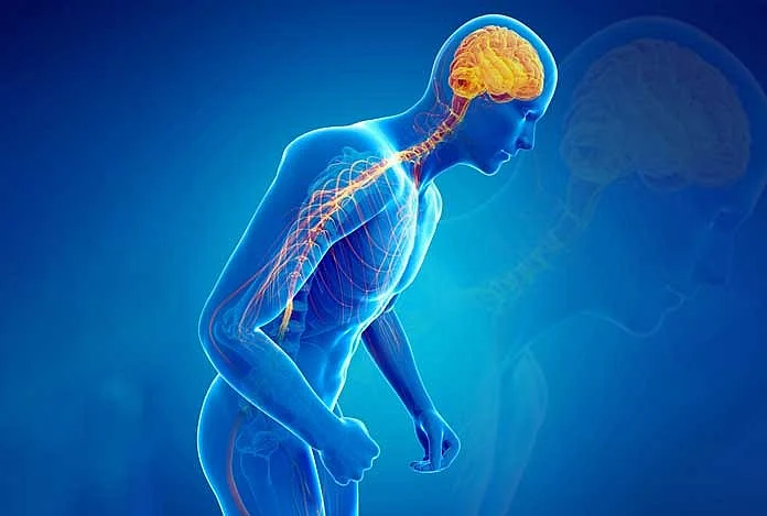 Illustration of Parkinson’s disease showing brain and nervous system degeneration affecting movement