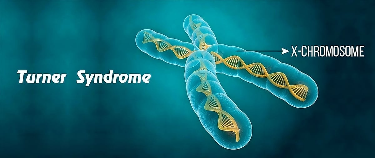 Early Diagnosis Brings Hope To Little Girl With Turner Syndrome