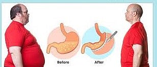 Amid Surge In Uncontrolled Diabetes, AIIMS Calls For Wider Access To Metabolic Surgery