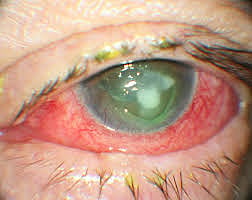 Short Human Peptide Shows Promise Against Deadly Fungal Eye Infections