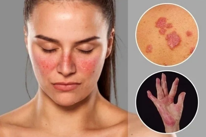 Winter Worsens Autoimmune Disease Risk For Women: AIIMS Expert