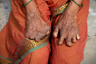 Multimorbidity Complicates Leprosy Care In India; Study Flags Systemic Gaps