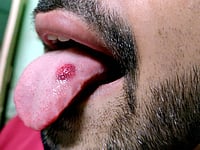 Distinct Molecular Drivers Identified In Oral Cancers Among Non-Smokers And Non-Drinkers