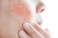 Self-Medication Gone Wrong: Common Painkillers Trigger Rare, Life-Threatening Skin Disorder