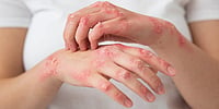 Beyond The Itch: Rising Atopic Dermatitis Cases Leaving Lasting Burden On Children And Families