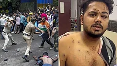 A 25-year-old protester displays injuries allegedly sustained during the July 20 CJP protest crackdown. - Outlook India