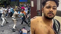 'Doctors Told Me These Were Pellets': Protester Undergoes Surgery After Delhi Protest Outlook India : A 25-year-old protester displays injuries allegedly sustained during the July 20 CJP protest crackdown.