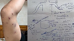 An Outlook reporter displays multiple puncture-like wounds sustained during the CJP protest - Outlook India