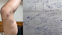 Outlook India : An Outlook reporter displays multiple puncture-like wounds sustained during the CJP protest