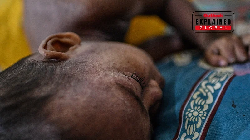 Child Rests While Receiving Treatment For Measles