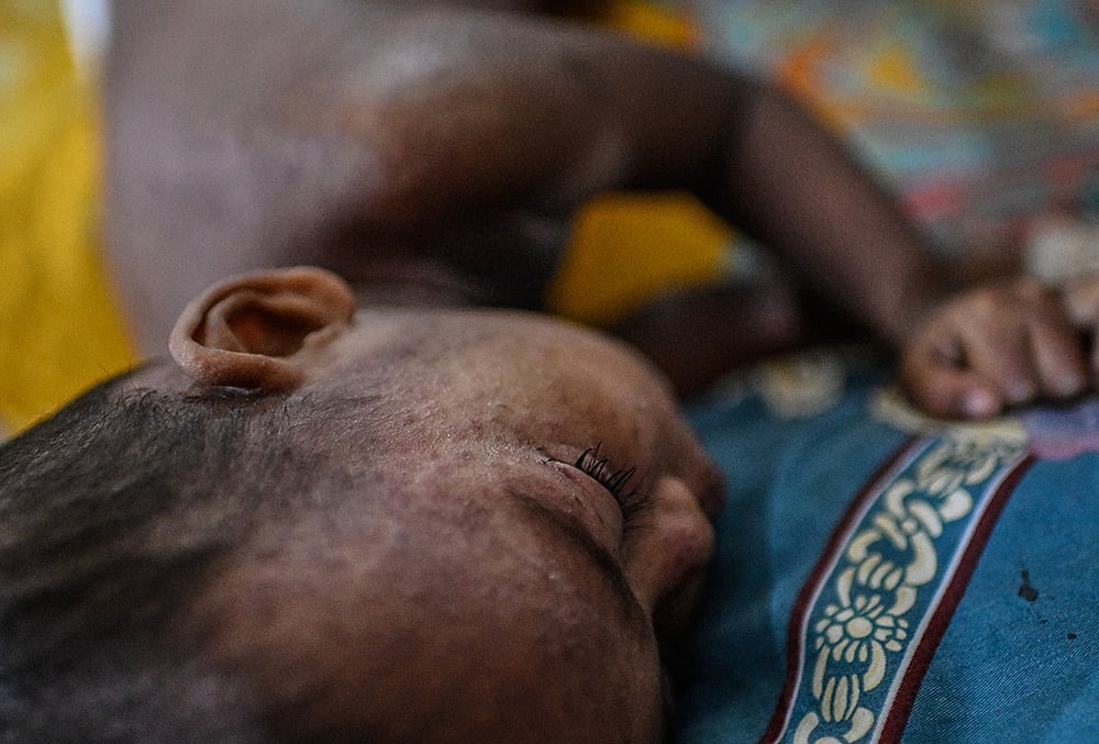 Measles hotspots Bangladesh
