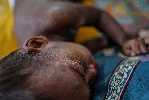 A child rests as he receives treatment during a measles outbreak in a hospital in Dhaka, Bangladesh, Tuesday, Sept. 8, 2026. 