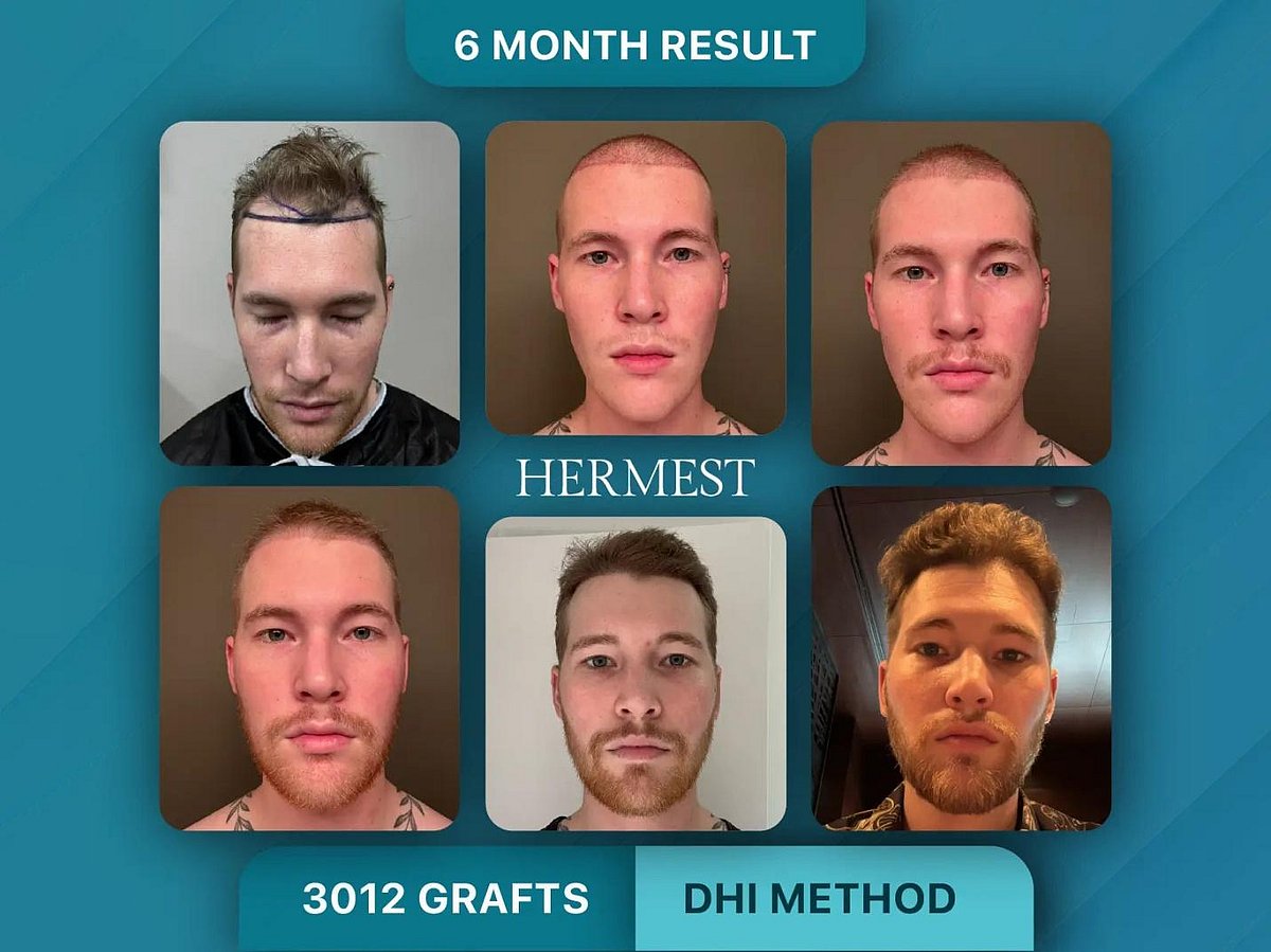 Collage showing a mans 6- month hair transplant results using the DHI method.