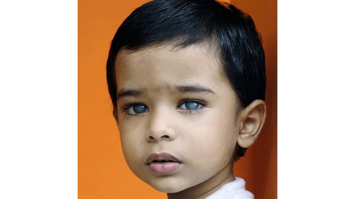 Children with glaucoma often reach care too late, AIIMS experts warn