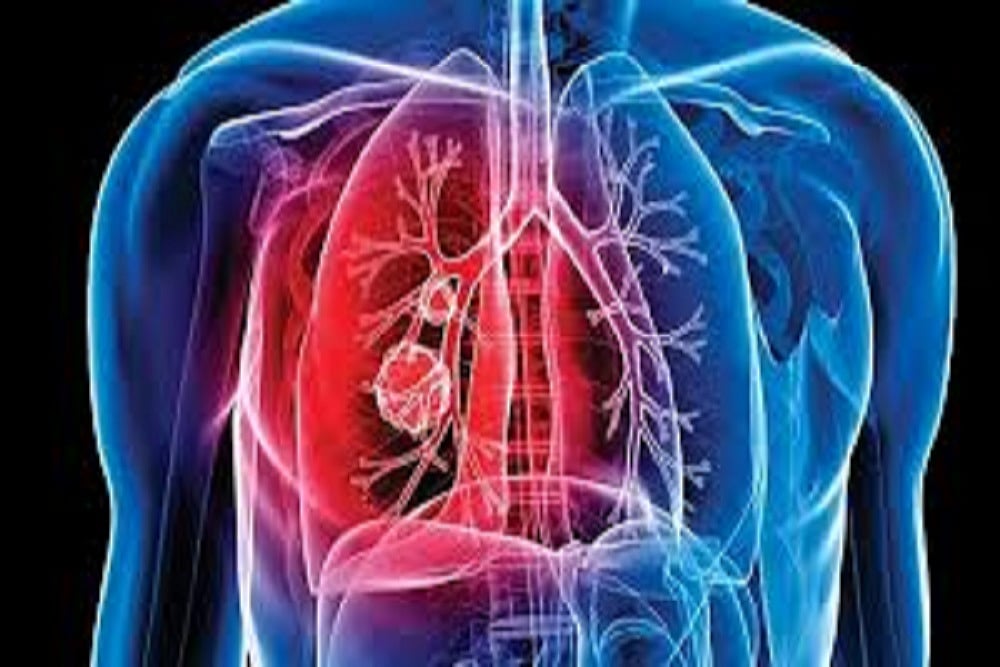 National Institute For Research In Tuberculosis Developing Sputum-Free Tests For Diagnosing TB