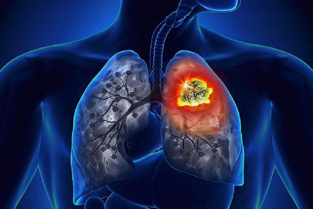 Lung Cancer  Is On The Rise For Women
