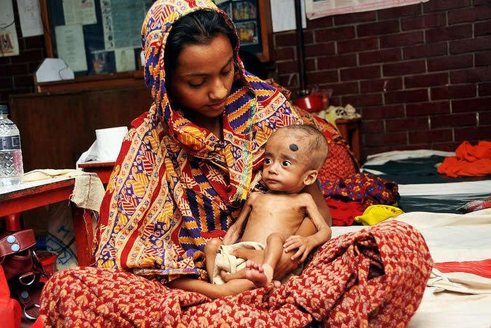 Fighting Severe Acute Malnutrition In India's Uttar Pradesh