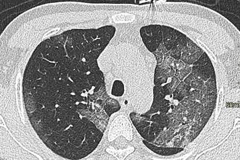 Pollution, Smoking And ‘Long Covid’...A Blow-by-Blow Account Of Drama That Could Play Out Inside Your Body - null