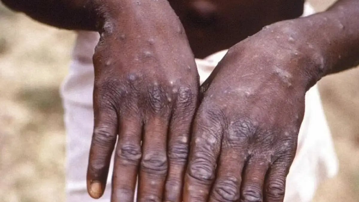 UAE Reports First Monkeypox Infection In Woman Who Returned From West Africa