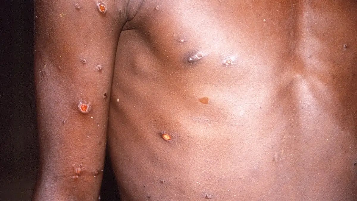 Monkeypox Patient In Delhi Stable, Had Painful Lesions: Report