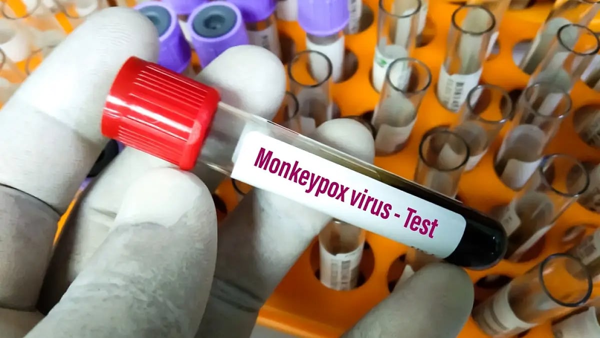 Suspected Monkeypox Case Found In Kerala, Samples Sent For Testing