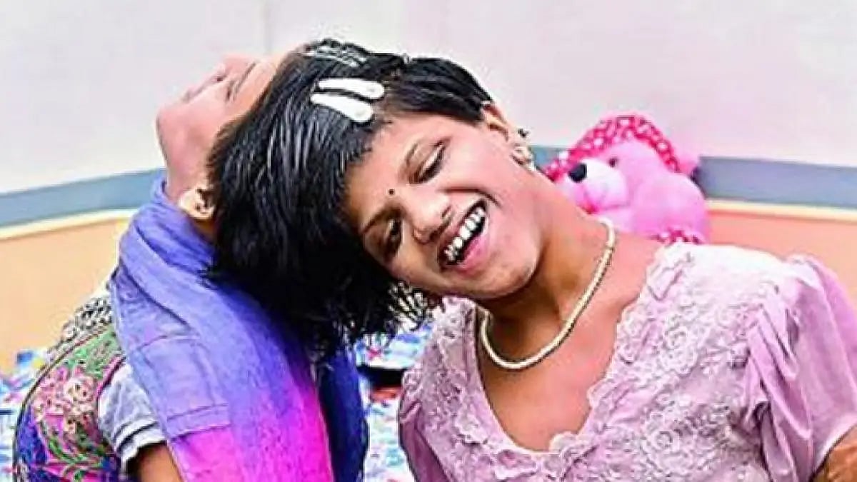 Co-joined twins Veena and Vani (Representational Image)