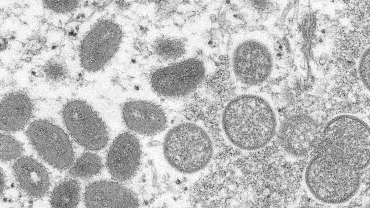 Monkeypox Suspect With Foreign Travel History Admitted To Delhi's LNJP Hospital: Sources