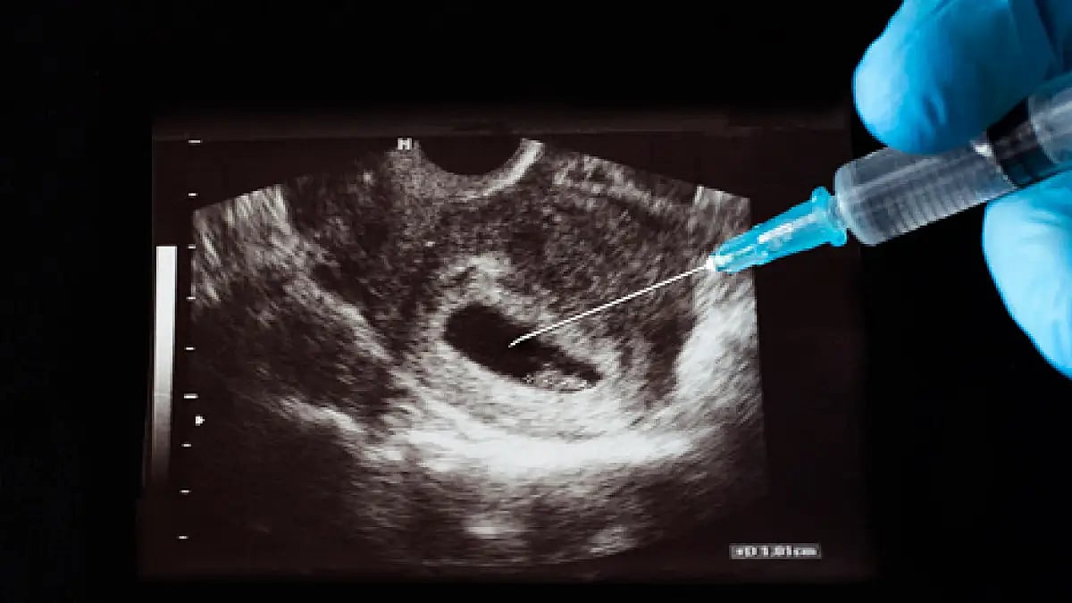 Womens right to safe abortion 