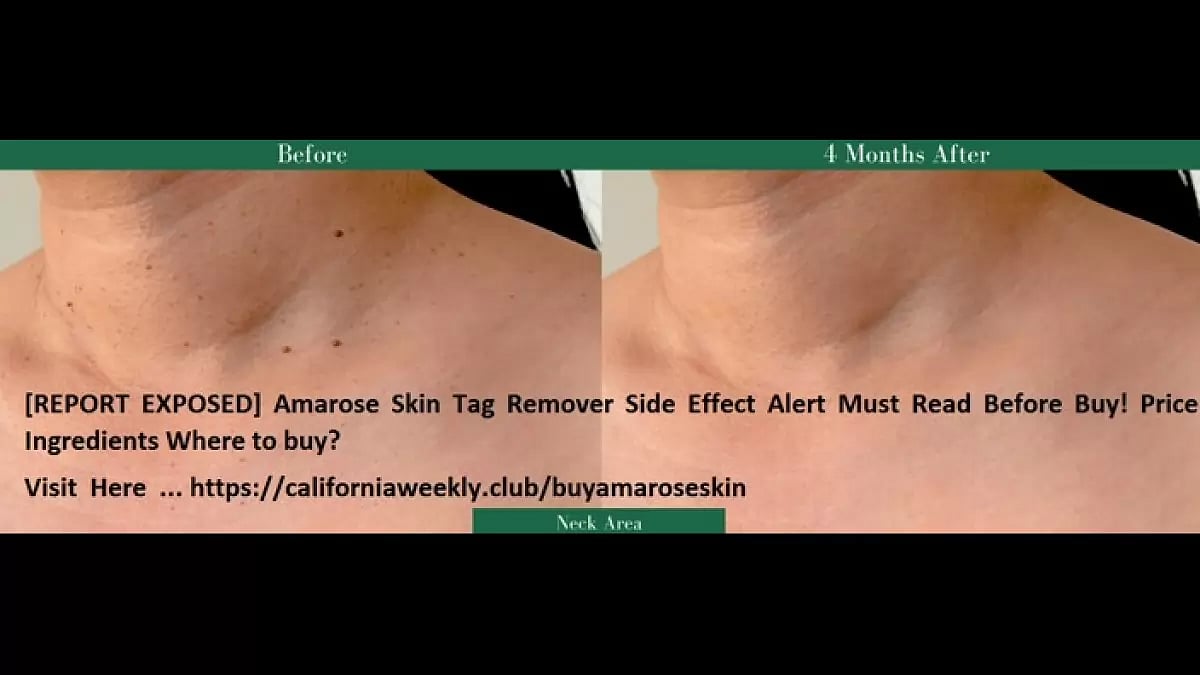  Amarose Skin Tag Remover