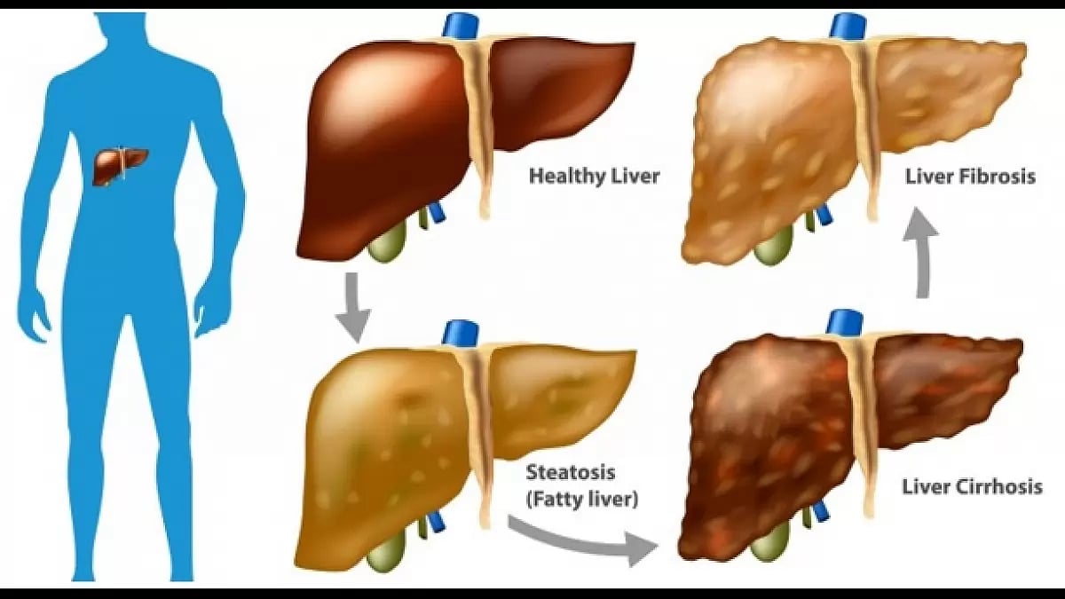NASH Cirrhosis