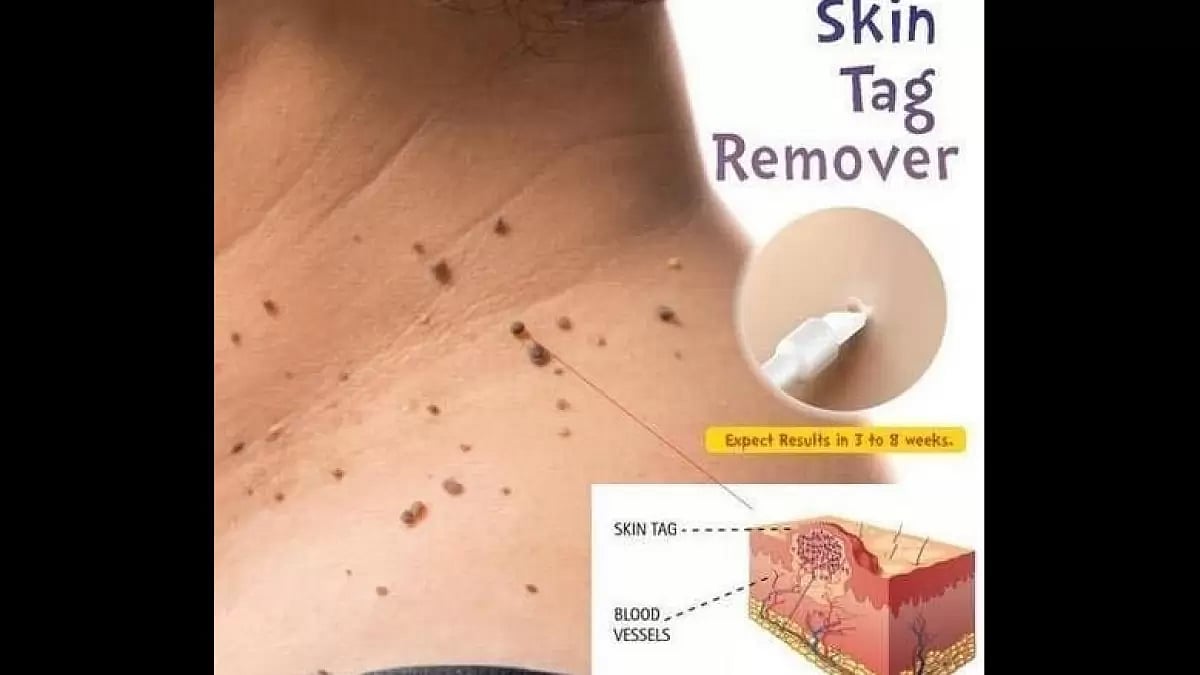 Bliss Skin Tag Remover