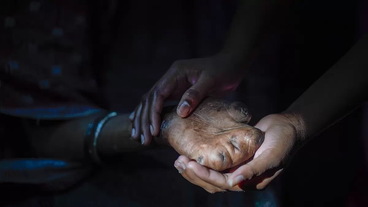World Leprosy Day - null
