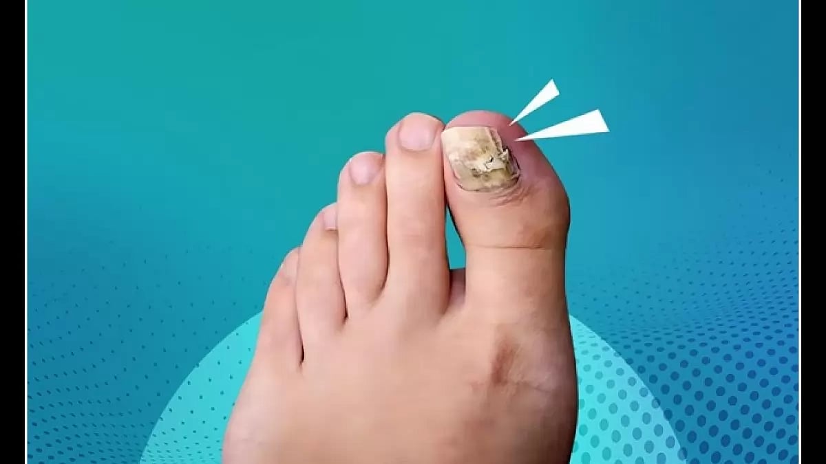 Best Toenail Fungus Treatments 