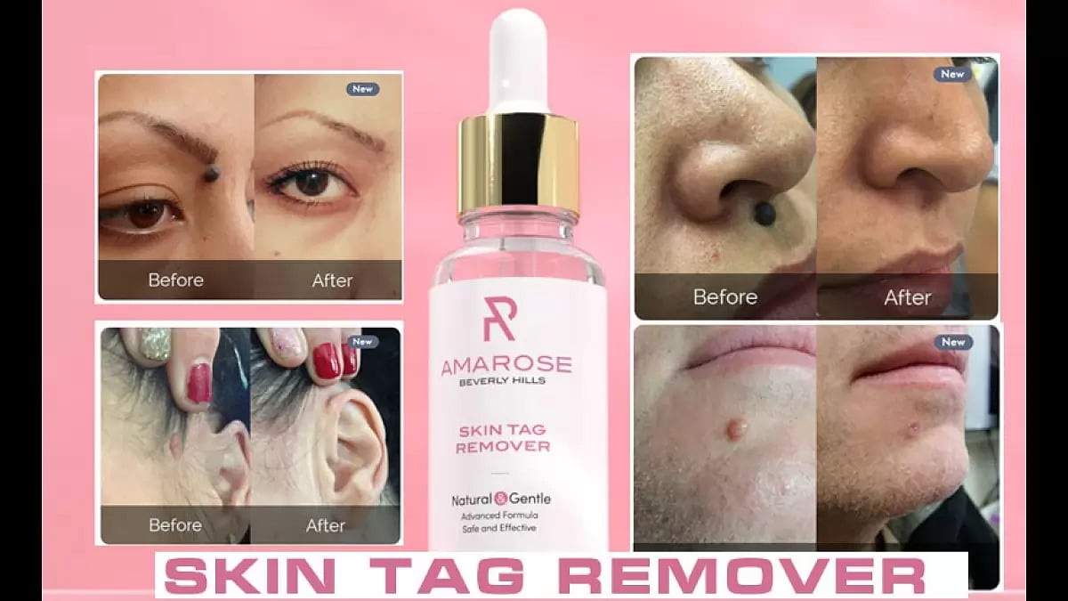 Skin Tag Remover