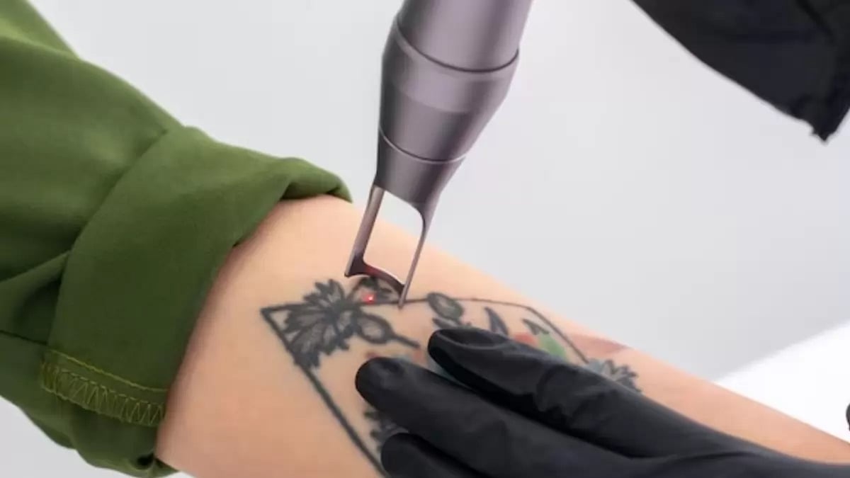 Tattoo removal industry in the US 