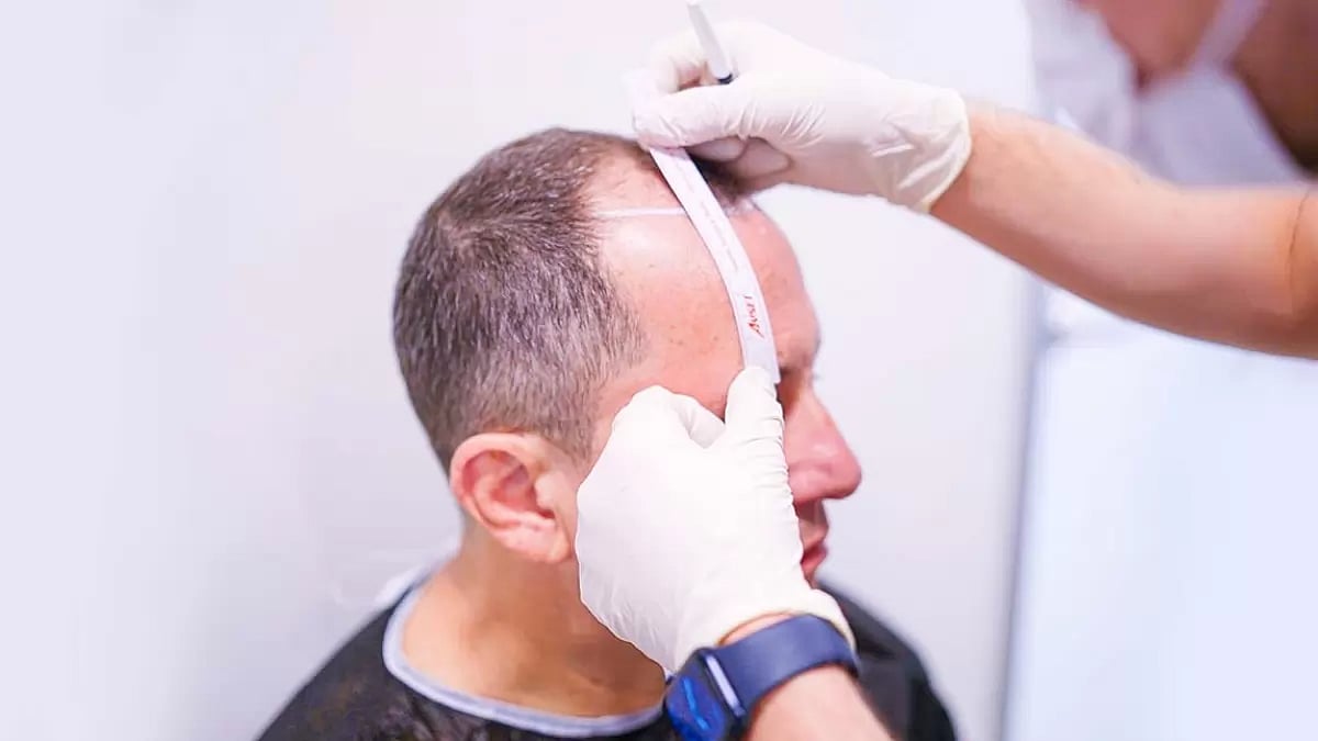 2024 Top 10 Best Hair Transplants In Turkey And Costs