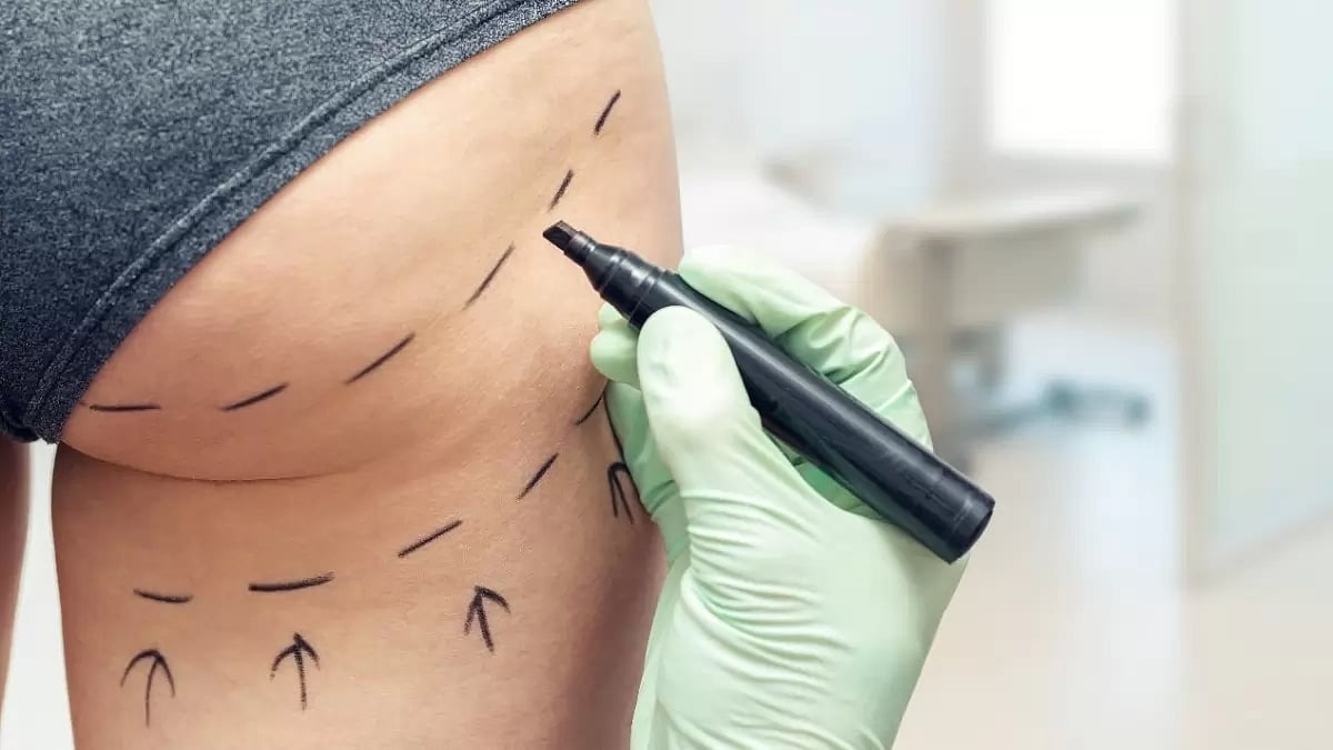 Best BBL (Brazilian Butt Lift) Surgeons In Miami Florida
