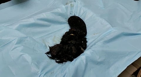 डोंबिवलीतील एका मुलीच्या पोटातून तब्बल ६५० ग्रॅमचा केसाचा गोळा बाहेर काढला 