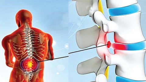 स्लिप डिस्कने त्रस्त आहात?, जाणून घ्या निदान आणि उपचार
