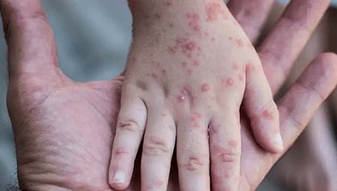 Monkeypox | कोरोनाच्या तुलनेत मंकीपॉक्स मुलांसाठी जीवघेणा, लक्षणे ‘चिकनपॉक्स’सारखी, ‘एम्स’ची माहिती
