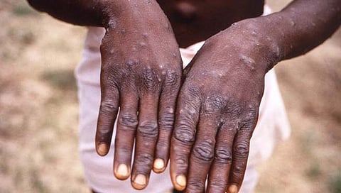 MonkeyPox : समलैंगिक संबधांतून अधिक फैलाव?