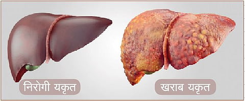 काविळीचा परिणाम थेट यकृतावर; ‘फॅटी लिव्हर’ची समस्या उद्भवणार्‍यांचे प्रमाण वाढले
