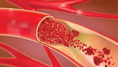 blood vessel: रक्‍तवाहिन्यांत चरबी जमा झाल्यास…